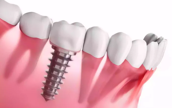 Immediate Dental Implantation in Turkey