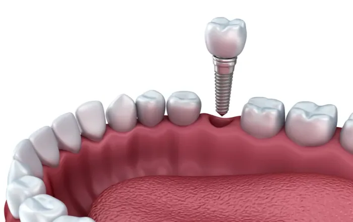 immediate-implant