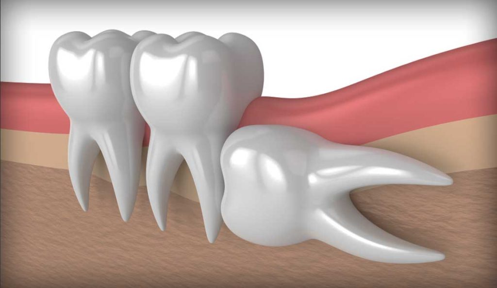 Impacted Wisdom Tooth
