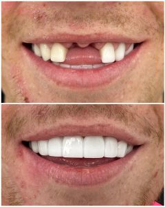 Dental implants before after