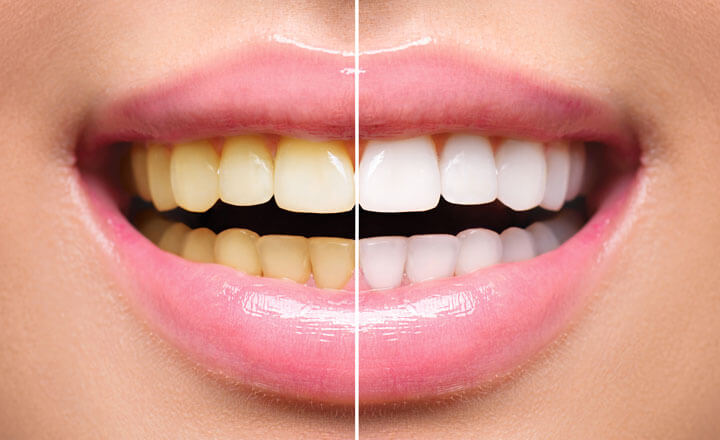 Teeth Whitening in Turkey