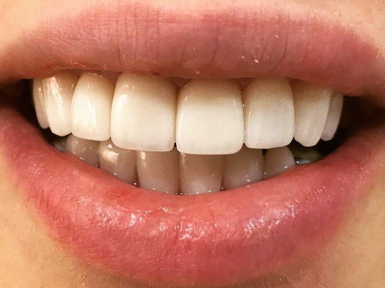 Front teeth with dark lines along the edge of the restoration — signs of marginal leakage and micro-infiltration