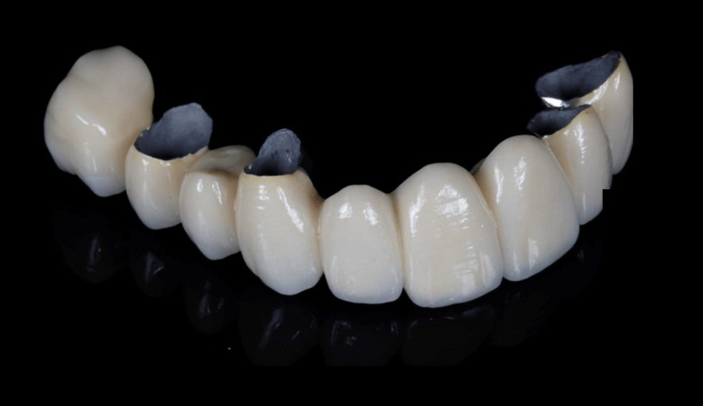 Metal Porcelain Crowns in Turkey