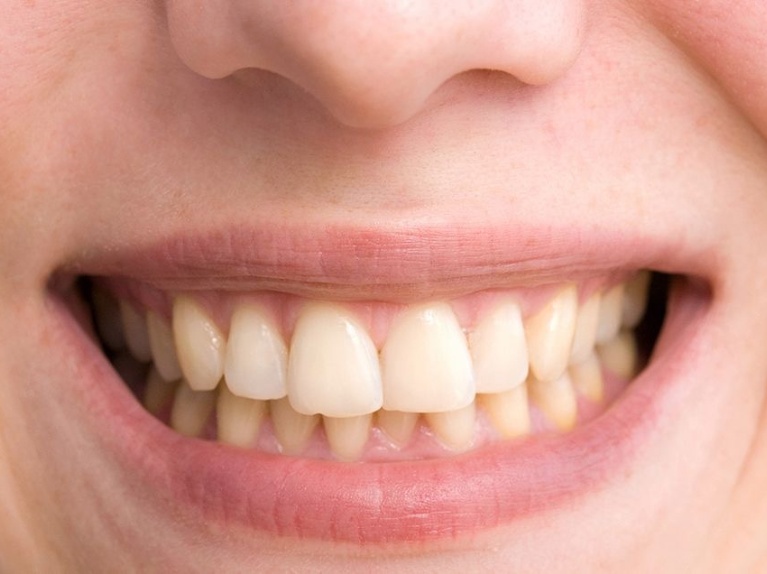 Composite restoration with a small chip visible on the edge (micro-chipping)