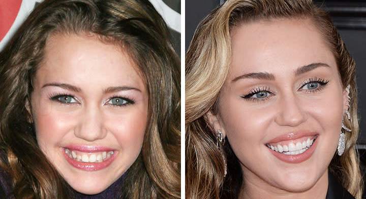 Miley Cyrus Teeth Before and After