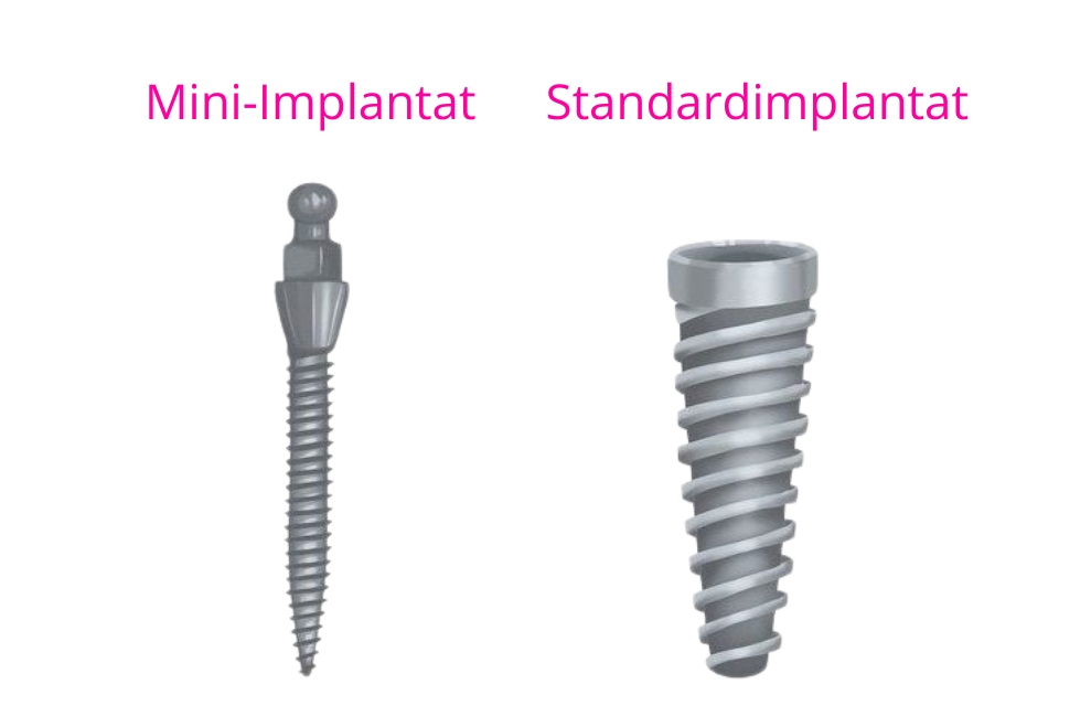 mini-implantaat versus standaardimplantaat