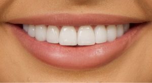 Natural Teeth Colour: What Is the Right Shade?