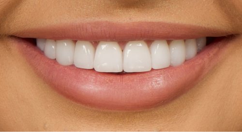 Natural Teeth Colour: What Is the Right Shade?