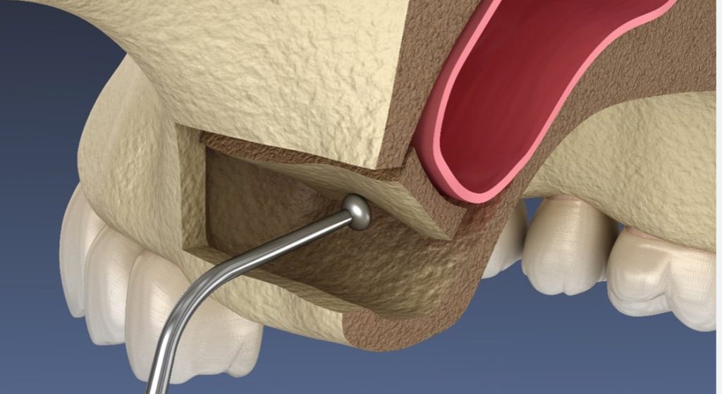 Open Sinus Lifting