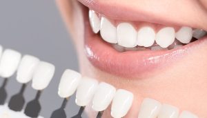 lamina veneers