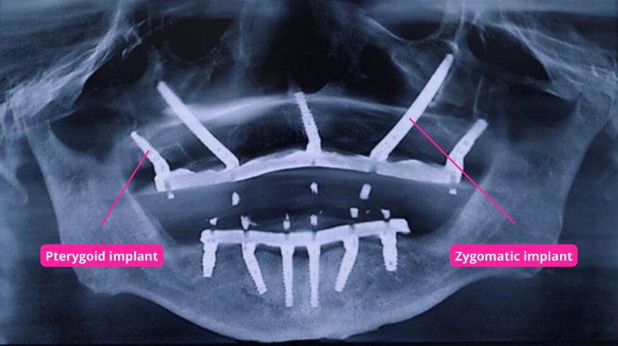 Maxillary radiograph displaying pterygoid and zygomatic implants for full arch rehabilitation