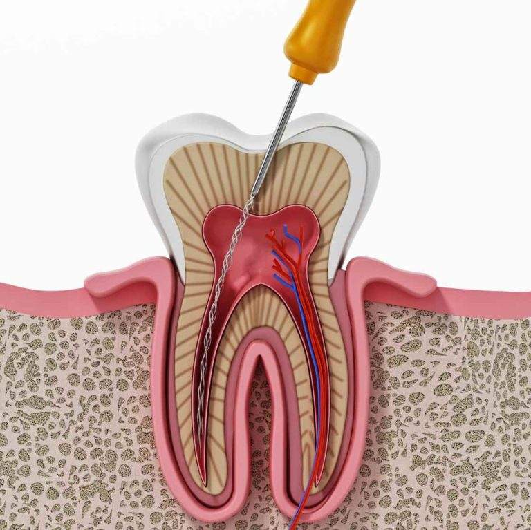 Root Canal Dental Treatment