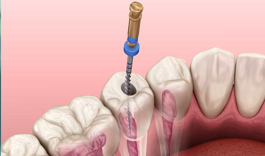 Root Canal dental treatment in Turkey
