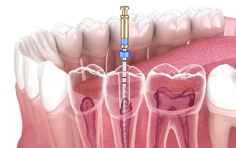 root canal treatment process