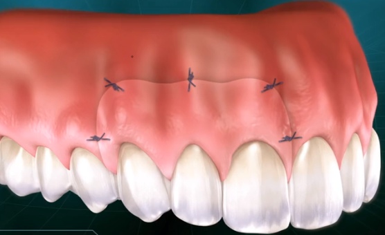 rotated flap transplantation