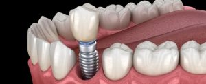Same Day Implant Treatment Performed