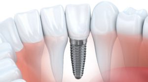 Same Day Dental Implants in Turkey