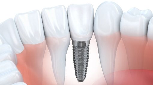 Same Day Dental Implants in Turkey