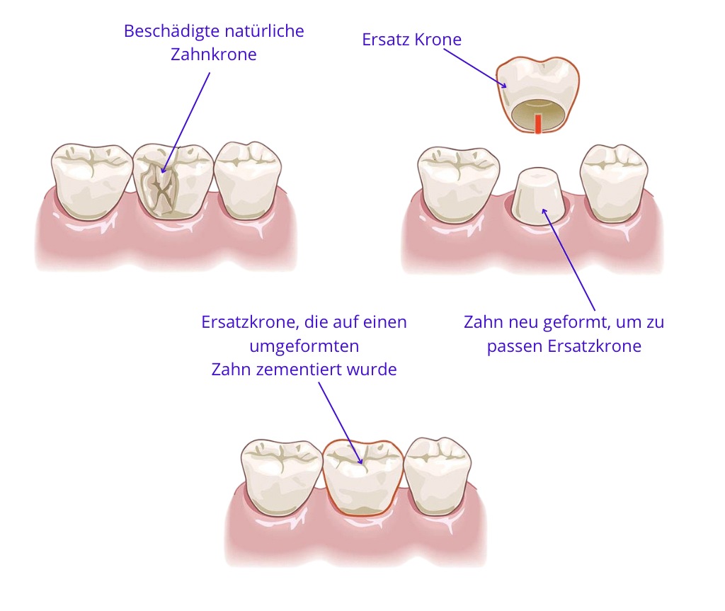 schema van een tandkroon
