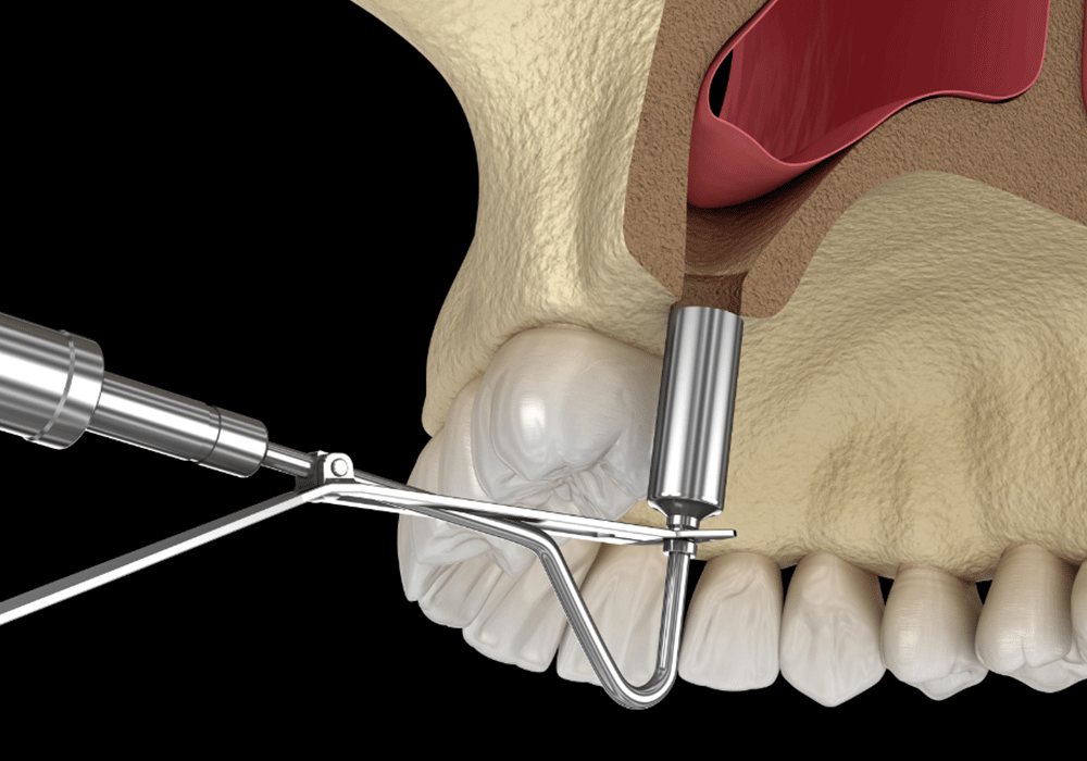 Sinus Lift Benefits