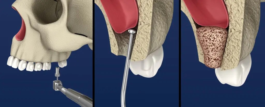 Dental Sinus Lift Procedure