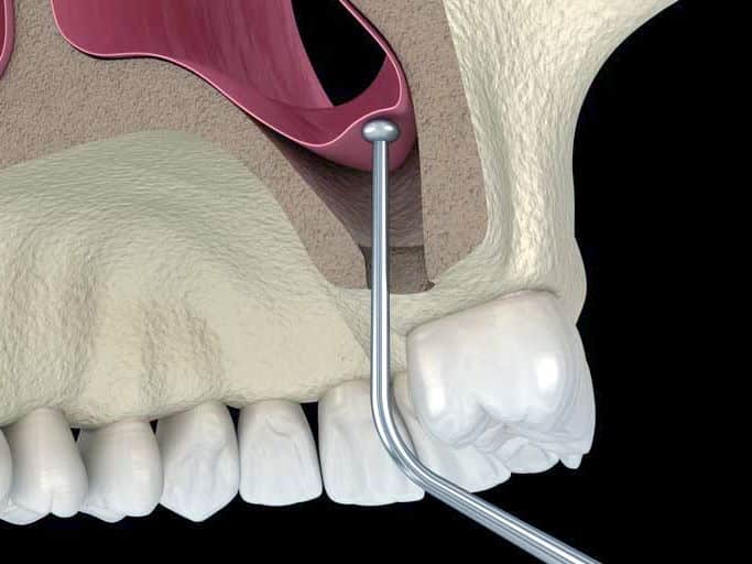 Sinus Lifting Surgery in Turkey