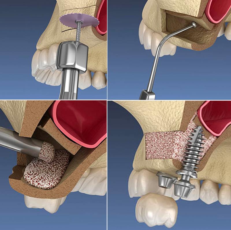 Sinus Lifting Performed