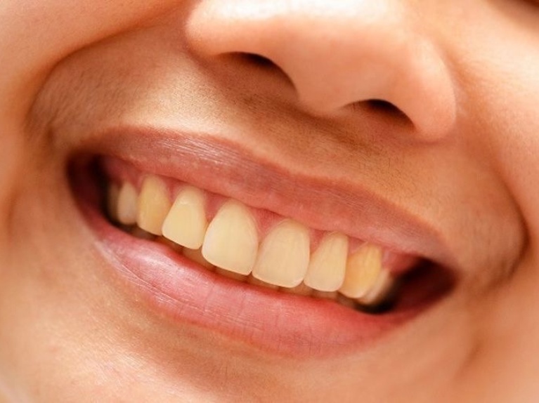 Front teeth with surface discoloration of the composite restoration