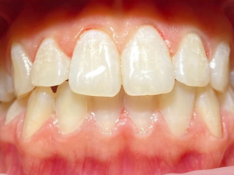 Front teeth with a dull composite restoration, showing areas of enamel wear and loss of gloss
