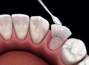 Surgical bone grafting