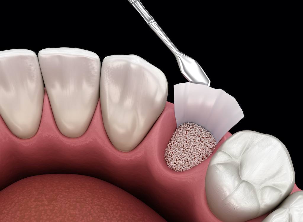 Surgical bone grafting