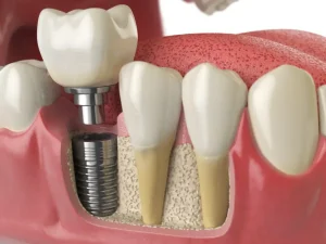 Teeth Implants in Turkey Reviews