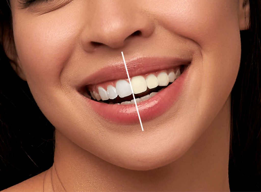 Teeth Whitening