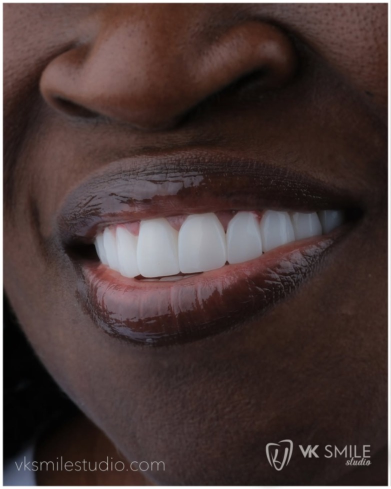 Professional Teeth Whitening in Turkey