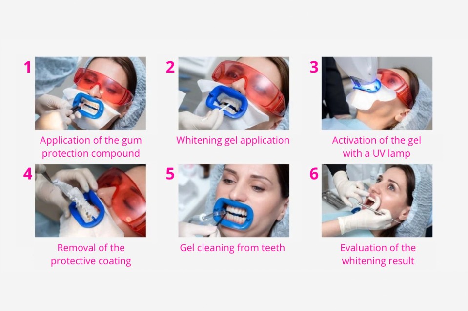 teeth whitening step-by-step