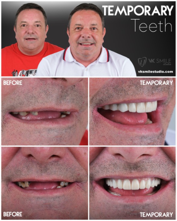 Same-day dental implants