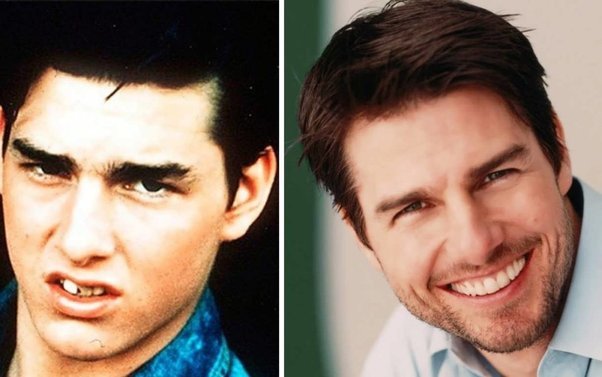 tom cruise teeth before and after