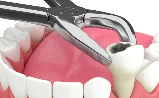 Tooth Extraction Performed?