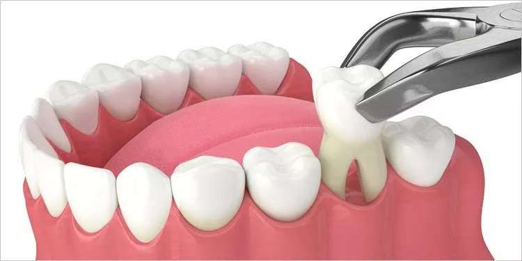 Tooth Extraction in Turkey
