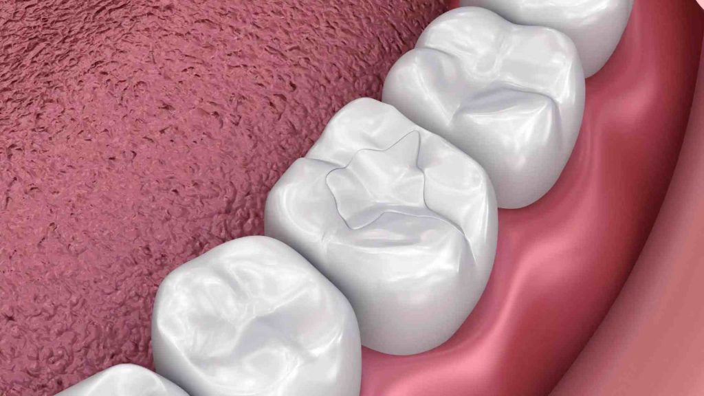 Tooth Fillings