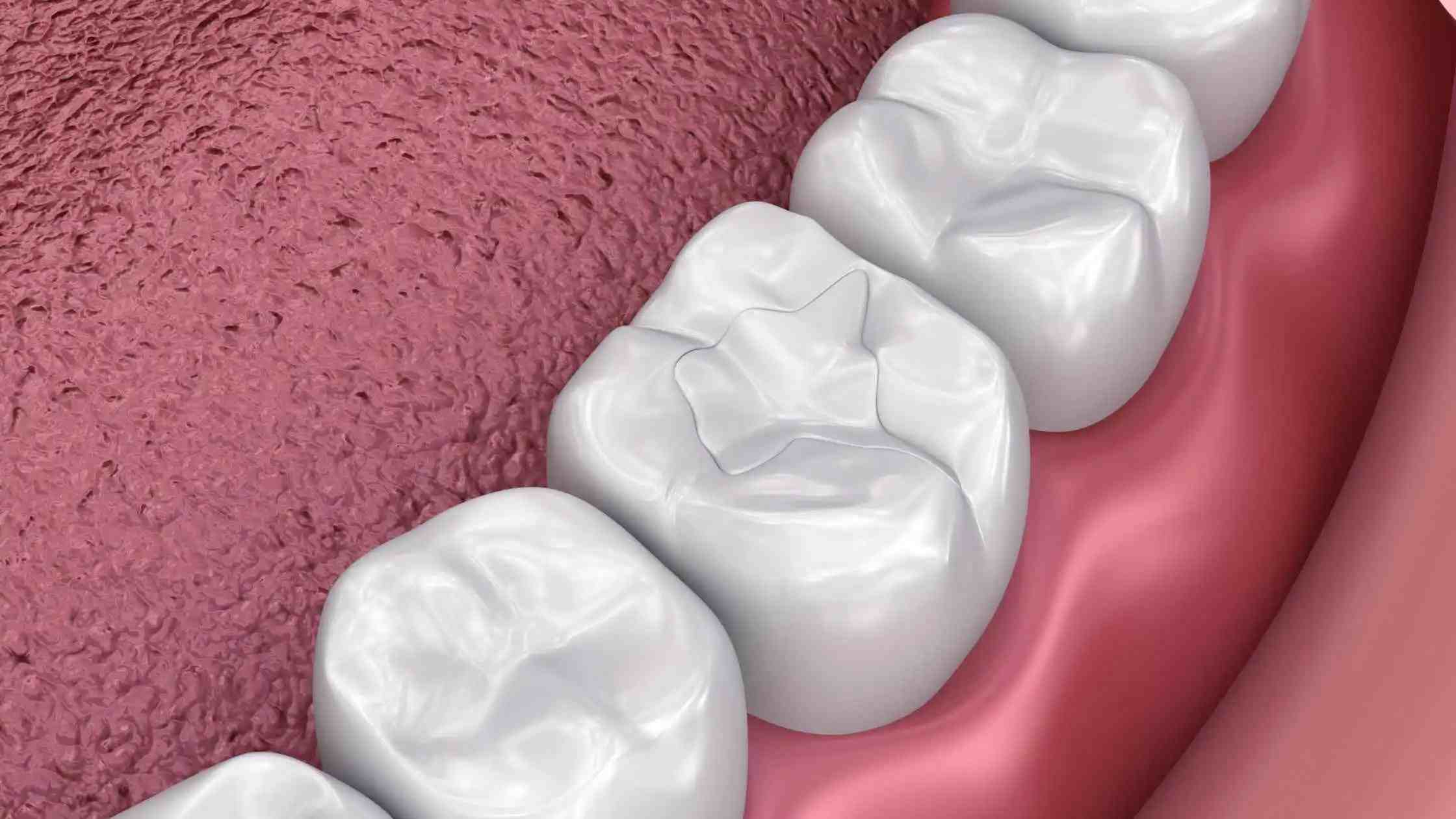 Tooth Fillings