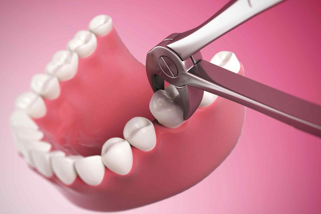 Tooth Removal Aftercare