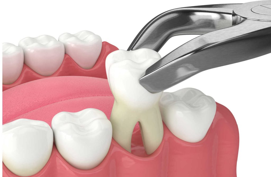 Tooth Removal Indications