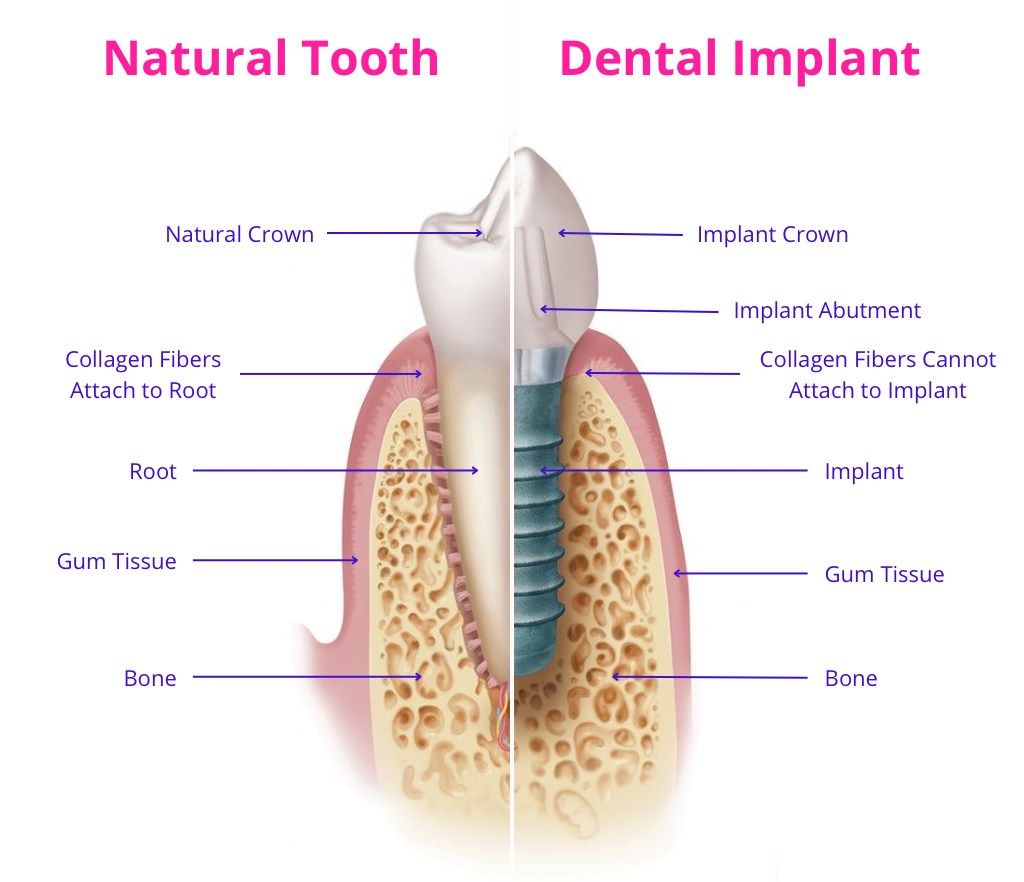 Schematic difference between an implant and a natural tooth