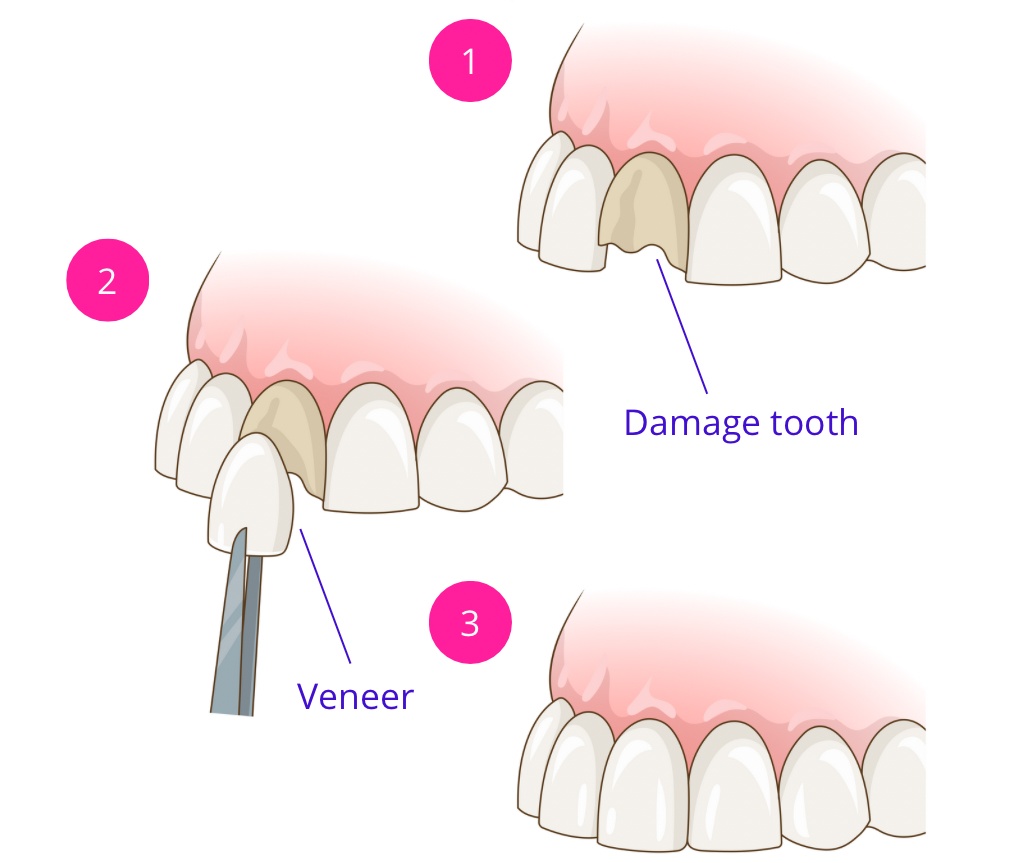 A schematic illustration of the veneer placement procedure