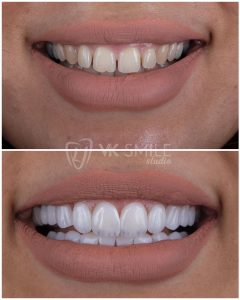 Dental veneers before after