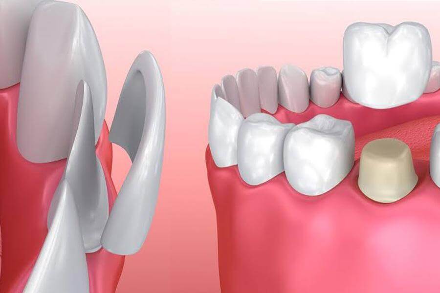 Dental Veneers or Dental Crowns in Turkey