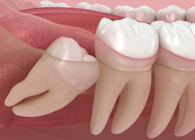 Wisdom Teeth