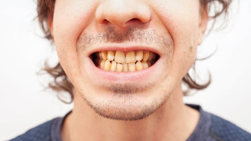 Why do teeth become yellow