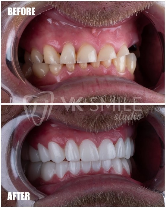 Before and after Hollywood smile design with porcelain veneers at VK Smile Studio